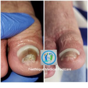 Fix ingrown nails. Correct Pincer and involuted nails