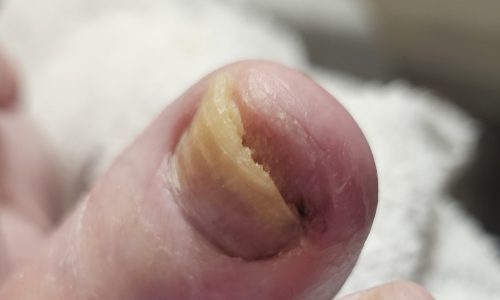 Fix nail fungus, clear nail fungus. Treat nail fungus in bratford.